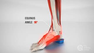 How to Treat Equinus  TOG  Try Vancouver Orthotics  6047373668 [upl. by Toblat308]