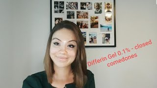 Differin Gel 01  closed comedones [upl. by Eisele542]