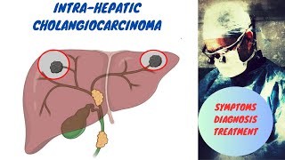 Intrahepatic Cholangiocarcinoma [upl. by Elfie976]