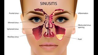 Chronic Sinusitis and just one homeopathic remedy amp 1 dose chronic sinusitis headache UrduHindi [upl. by Melbourne]