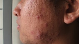 What Is Cystic Acne  Acne Treatment [upl. by Stetson]