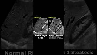 Fatty Liver Grading On Ultrasound  Hepatic Steatosis Grades 123  Normal Vs Abnormal USG shorts [upl. by Ahsimrac]