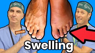 Foot and Ankle Swelling What Causes It [upl. by Kcirdehs854]