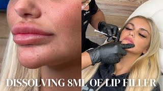 Dissolving 8ml of Lip Filler Insane Results [upl. by Kassel]