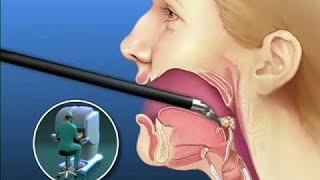 Tongue Cancer surgery 3D Animation video by medicalhelp50 [upl. by Okechuku647]