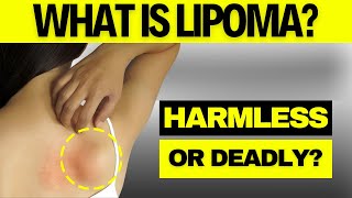 What is Lipoma Harmless or Deadly [upl. by Rufina]