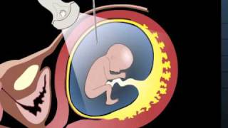 Prenatal test  Amniocentesis  Fetal medicine [upl. by Slack]