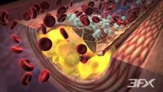 DiabetesRelated Atherosclerosis [upl. by Eellehs]