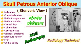 Skull Petrous Anterior Oblique View Stenvers view  स्टेनवर्स View in Hindi Skull radiography [upl. by Ocir]