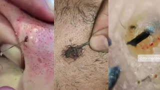 Super Satisfying Ingrown Hair Removal💚Ingrown Hair Removal 2022💚TiKTok Compilation [upl. by Brasca202]