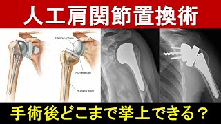 人工肩関節置換術についての詳細解説：手術から回復まで [upl. by Ainocal]