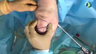 SREDDY MPFL RECONSTRUCTION EDUCATIONAL VIDEO FOR ORTHOPAEDIC SURGEONS [upl. by Dielle]