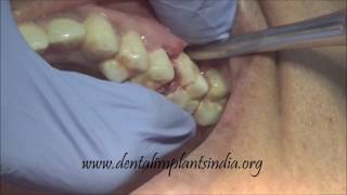 How to use luxator and forceps to remove upper decayed first molar [upl. by Kciremed624]