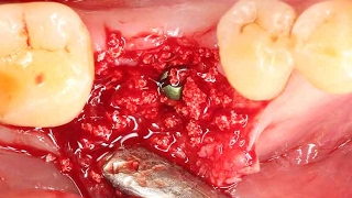 Clinical application of OSTEON™ lll Dentium alloplastic graft [upl. by Sedgewinn]