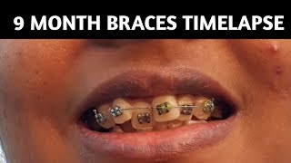 Braces 9 Month Timelapse  Smile Transformation [upl. by Waverley]