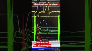 Wpw kent et ablation  les critères de rythmologue [upl. by Booth]