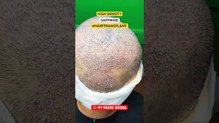 Crown Hair Restoration crown area hair hairtransplant fue sapphirehairtransplant shorts [upl. by Maxima]