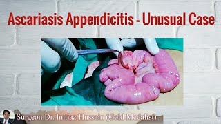 Unusaul Case of Ascariasis Appendicitis  Surgeon Dr Imtiaz Hussain [upl. by Tereb]