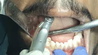 live alveoloplasty for increasing prosthetic space for lower molars replacement with implants [upl. by Waki]