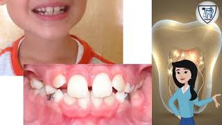 बच्चों में टेढ़े मेढ़े दांत निकलने का कारण  Ugly Duckling Stage Temporary Malocclusion in Kids [upl. by Mahmud]