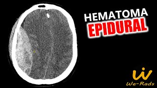 Hematoma Epidural [upl. by Bovill154]