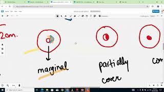 ANTEPARTUM HAEMORRHAGE DISCUSSION [upl. by Malloy821]