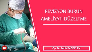 Revizyon Burun Ameliyatı Düzeltme [upl. by Post]