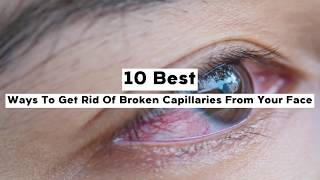 10 Best Ways To Get Rid Of Broken Capillaries From Your Face [upl. by Liagibba]