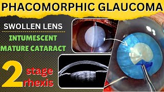 Phacomorphic glaucoma amp Intumescent mature cataract with swollen lens 2stage rhexis  Dr Deepak M [upl. by Errecart860]