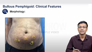 E6 Sample Video Pemphigoid Group of Bullous Disorders Dermatology [upl. by Peltier]