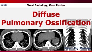 Diffuse Pulmonary Ossification case review [upl. by Nnylimaj]