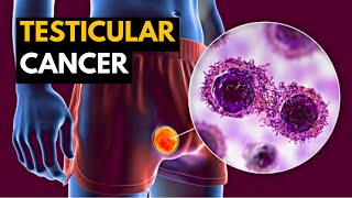 Testicular Cancer Causes Signs and Symptoms Diagnosis and Treatment [upl. by Arde]