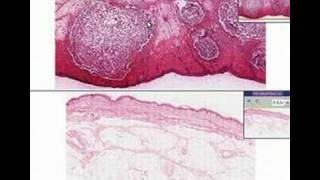 Histopathology Skin Furuncle abscess [upl. by Eada]