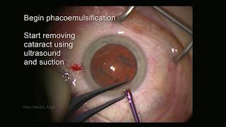 Mrs Pam Addley  Review on Lens Replacement Surgery RLE with EDOF Toric lenses [upl. by Arrekahs901]