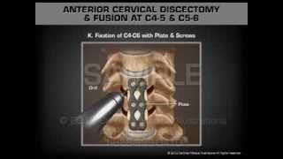 Anterior Cervical Discectomy amp Fusion at C45 and C56 [upl. by Veedis]