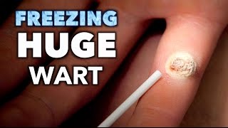 Freezing a HUGE INFECTED WART with liquid nitrogen  Dr Paul [upl. by Ateinotna]