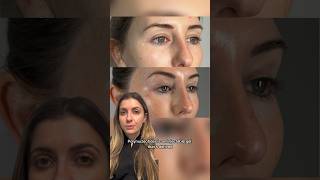 Polynucleotides for undereye rejuvenation  Dr MediSpa [upl. by Ellerret558]