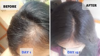 OMG  15 Days Hair Growth Miracle Treatment  Grow Long Thicken Hair  100 works [upl. by Eilatam376]