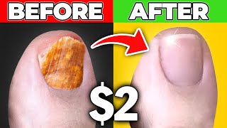 Get Rid Of Toenail Fungus for Good Dr Bergs 200 Cure [upl. by Leiva999]