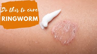 Ringworm Fungal infection I Dr Surbhi MD [upl. by Highams]