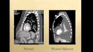 Thoracentesis [upl. by Kraft858]