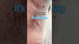 Removing an Underarm Skin tag shorts CONTOUR DERMATOLOGY [upl. by Hildegard518]