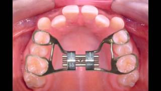 Rapid Palatal Expander [upl. by Eniagrom328]