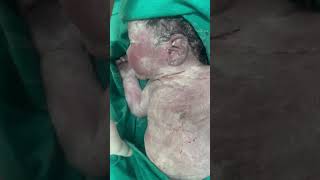 Vernix caseosa a protective sensitive newborn skinnewborn baby ❤️ [upl. by Greiner]