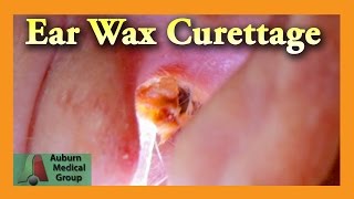 Ear Wax Removal of a Full Ear  Auburn Medical Group [upl. by Ydarg]