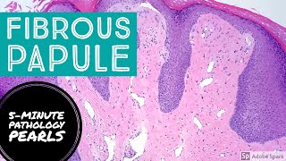 Fibrous Papule Angiofibroma 5Minute Pathology Pearls [upl. by Aehta799]