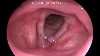 Video Laryngoscopy  How Vocal Polyp Look Like [upl. by Gabbey]