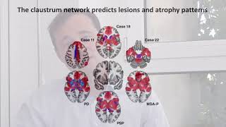 Localizing parkinsonism based on focal brain lesions [upl. by Grekin]