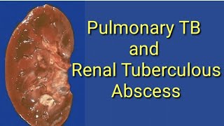 Pulmonary Tuberculosis Dissimination into Renal Tuberculous Abscess on CT Imaging [upl. by Auliffe]