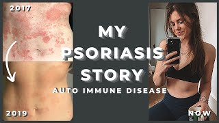 Psoriasis  How I Deal With and Manage Autoimmune Disease Diet Treatment Body Confidence [upl. by Mastrianni]